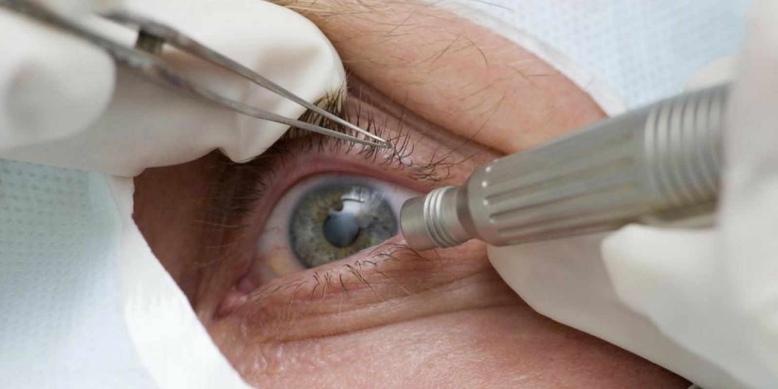 Ceratocone: campanha Junho Violeta alerta sobre a doença ocular
